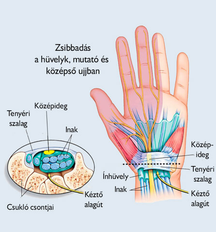 Kéztőalagút szindróma