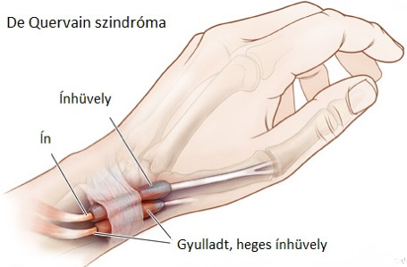 csukló fájdalom betegség csípő zömök artrózis