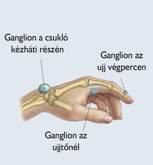 Kézháti / tenyéri ganglion eltávolítás