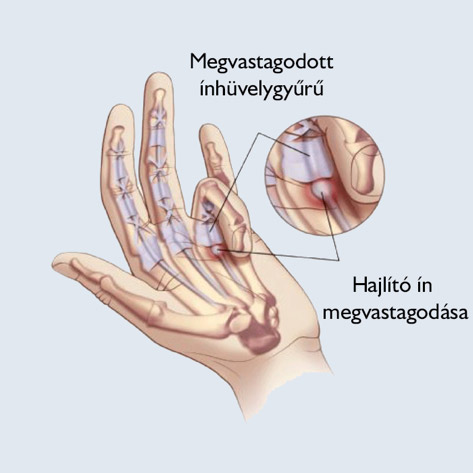 Az ujjak törése: okok, tünetek, diagnózis, kezelés