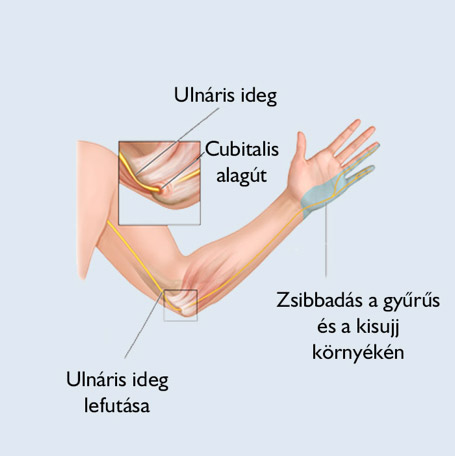 A kéztő alagút, vagyis carpalis alagút szindróma tünetei, gyógyítása - Gerincfórum